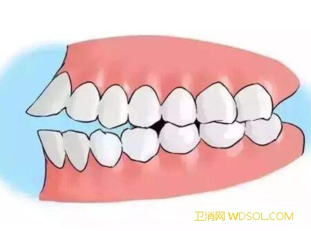 儿童牙齿畸形的种类_上颌-畸形-拥挤-牙齿-