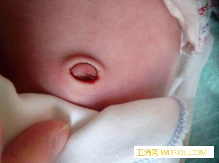 新生儿脐带发炎的后果_菌血症-败血症-脑膜炎-脐带-