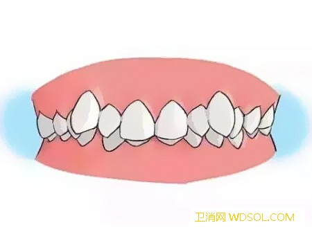 儿童错颌畸形的症状_牙龈炎-牙周病-牙龈-错位-