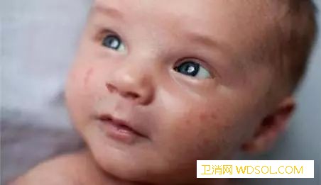 宝宝湿疹什么原因引起的可能这几点没做好_湿疹-护理-皮肤-因素-